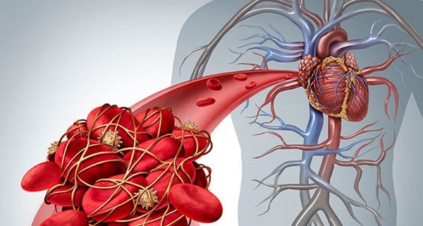 How IVC Filters Can Sometimes Be Dangerous For People