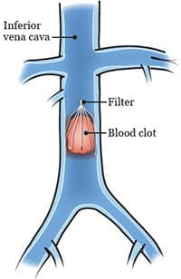 IVC filters