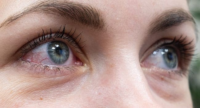 Pink eye may be primary symptom of COVID-19