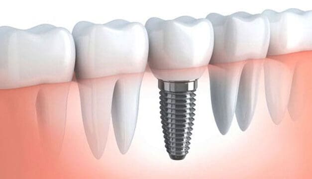 Frequently Asked Questions about Dental Implants