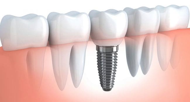 Frequently Asked Questions about Dental Implants