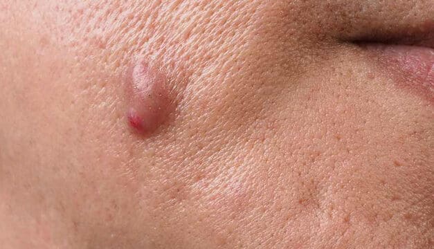 Banish Breakouts: Transforming Your Life While Living with Cystic Acne