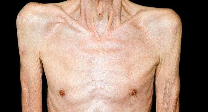 Muscle wasting syndrome cause of many cancer-related deaths